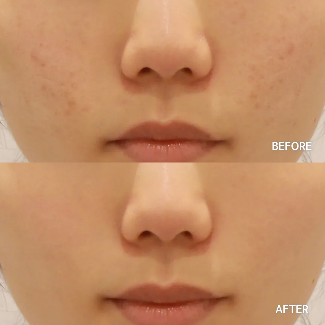 Juvelook before and after — firmer, more restored skin surface, Dear Clinic case