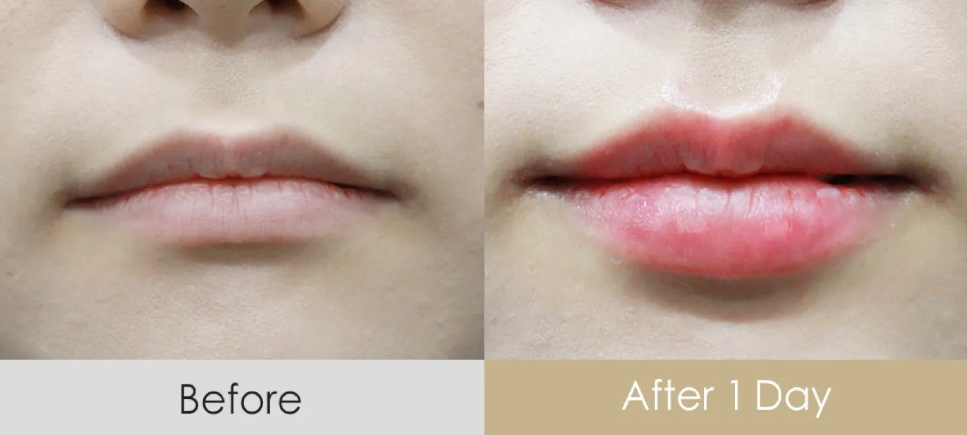 Lip filler before and after — Dear Clinic case