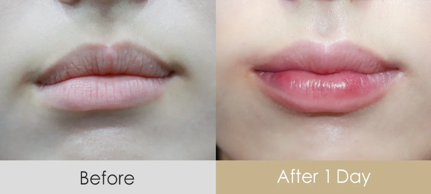 Lip filler before and after — Dear Clinic