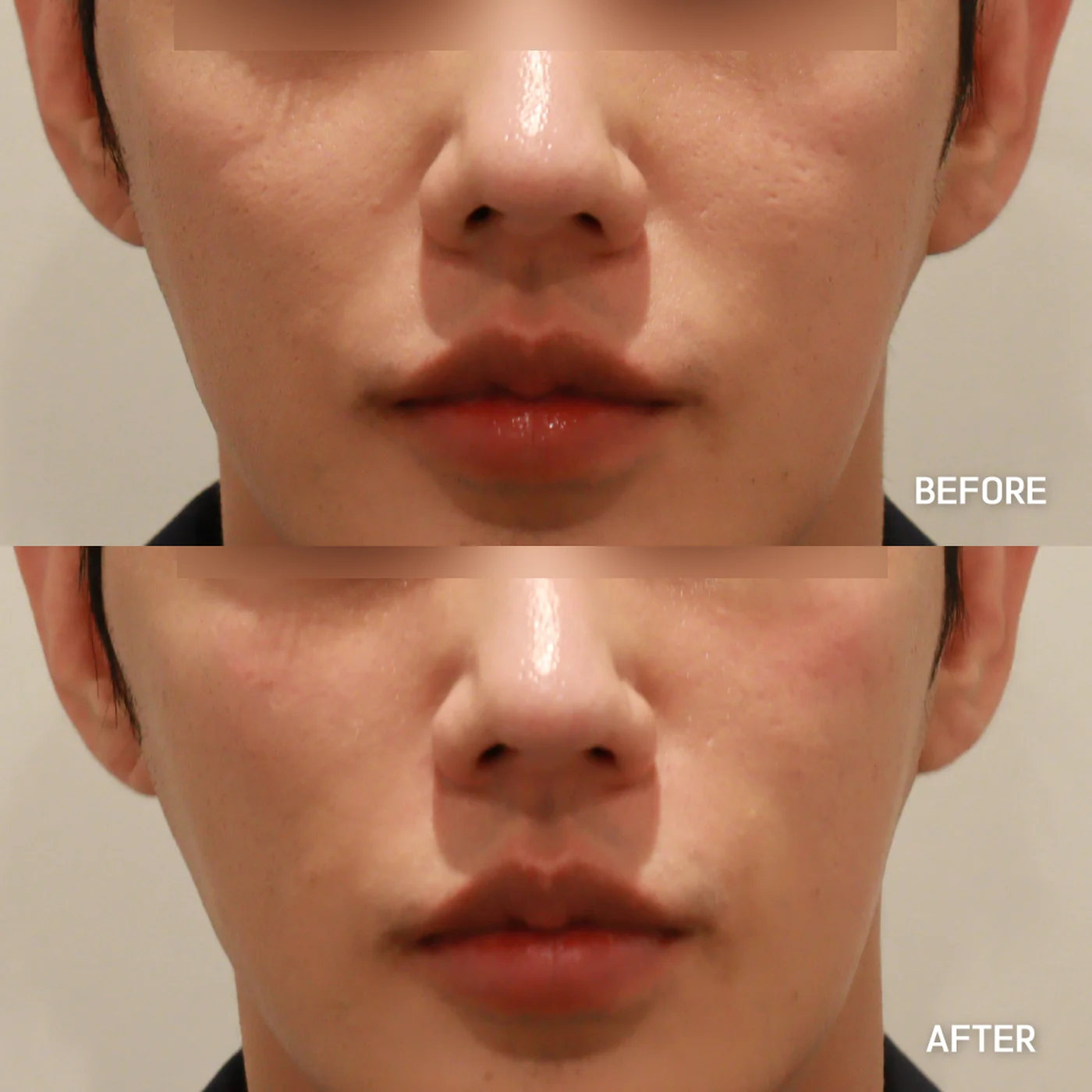 Nasolabial fold filler before and after — same patient, softened smile lines, Dear Clinic case
