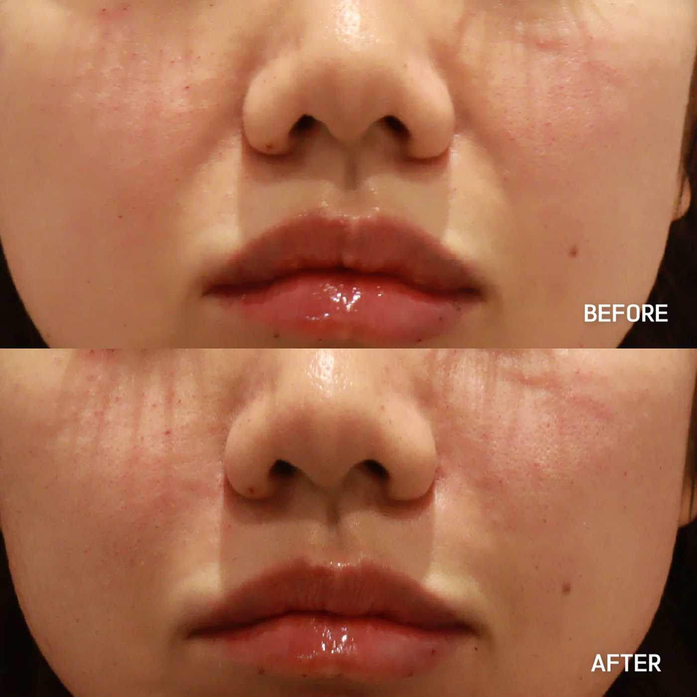 Nasolabial fold filler before and after — same patient, smoother mid-face transition, Dear Clinic case