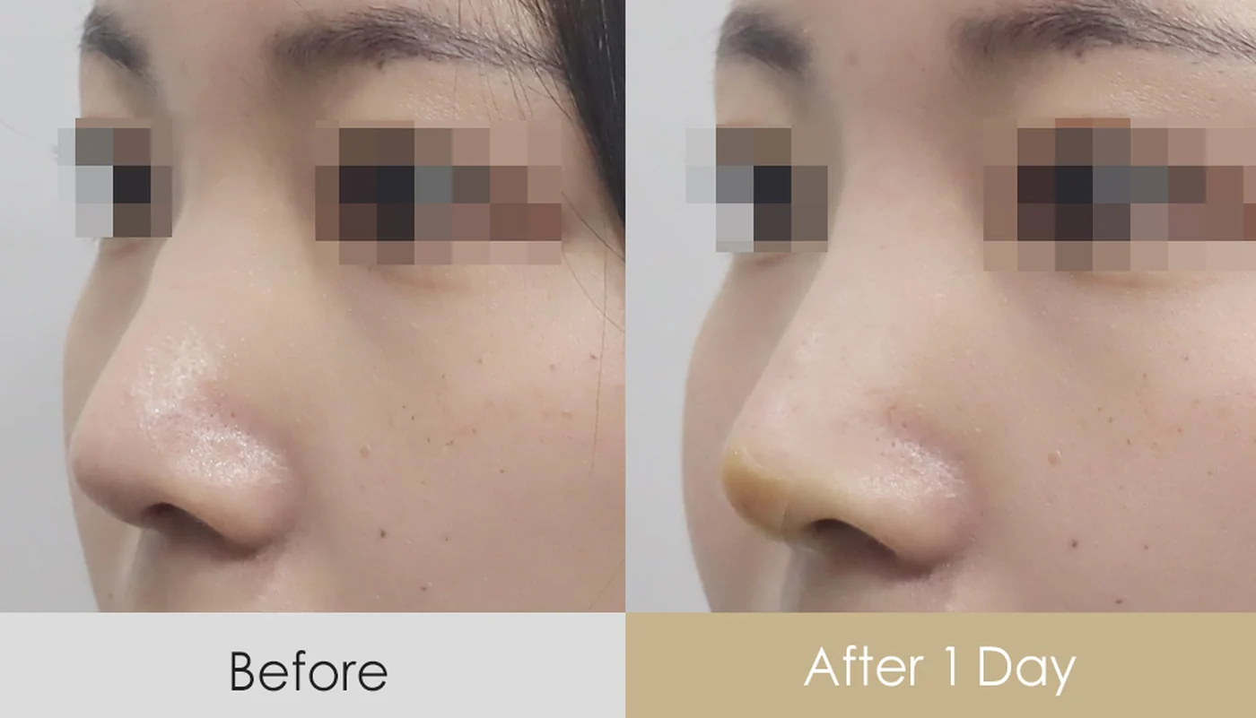 Nose filler before and after — same patient, side profile, raised, straighter bridge, Dear Clinic case