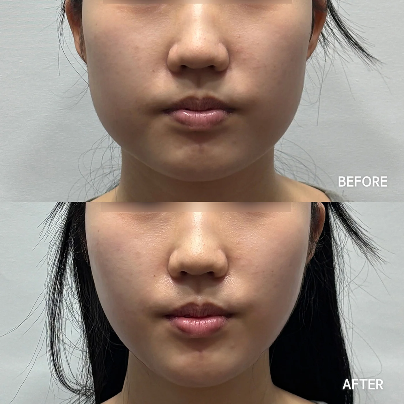 Onda Coolwaves before and after — same patient, front view, firmer jawline, Dear Clinic case