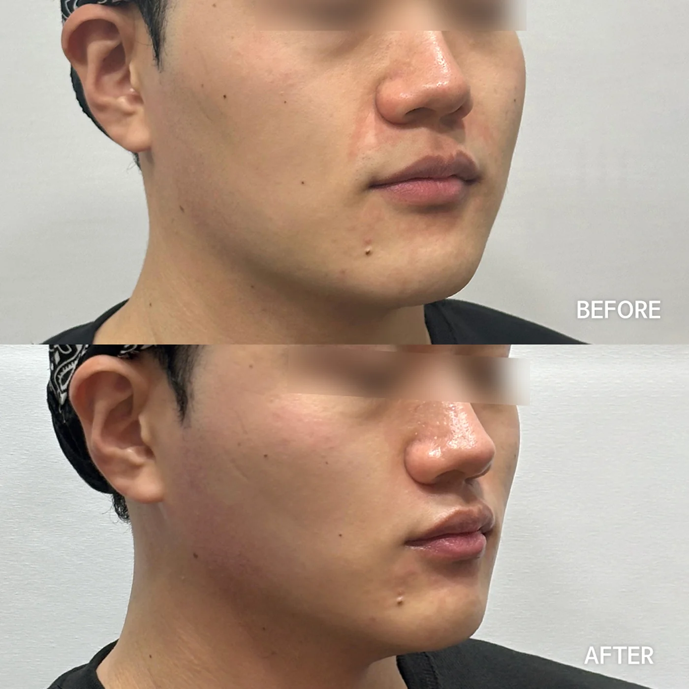 Onda Coolwaves before and after — same patient, side profile, tighter lower-face contour, Dear Clinic case