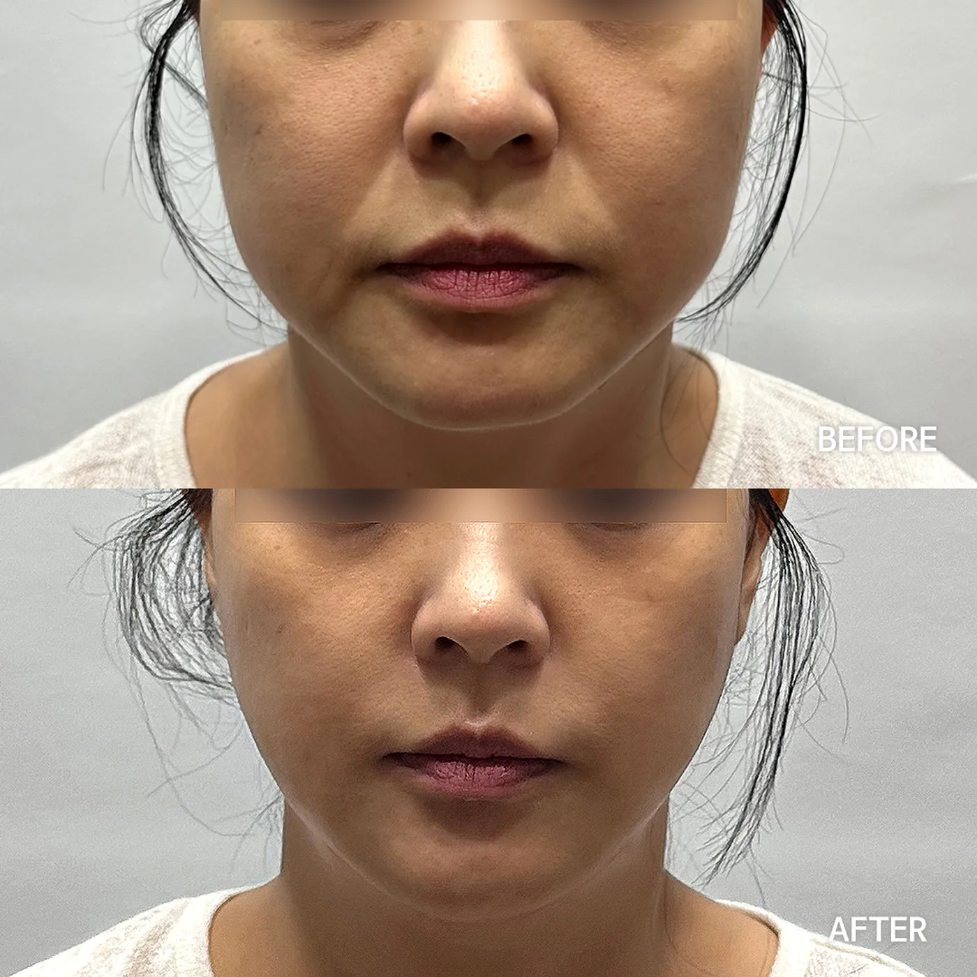 Onda Coolwaves before and after — same patient, front view, firmer lower-face contour, Dear Clinic case