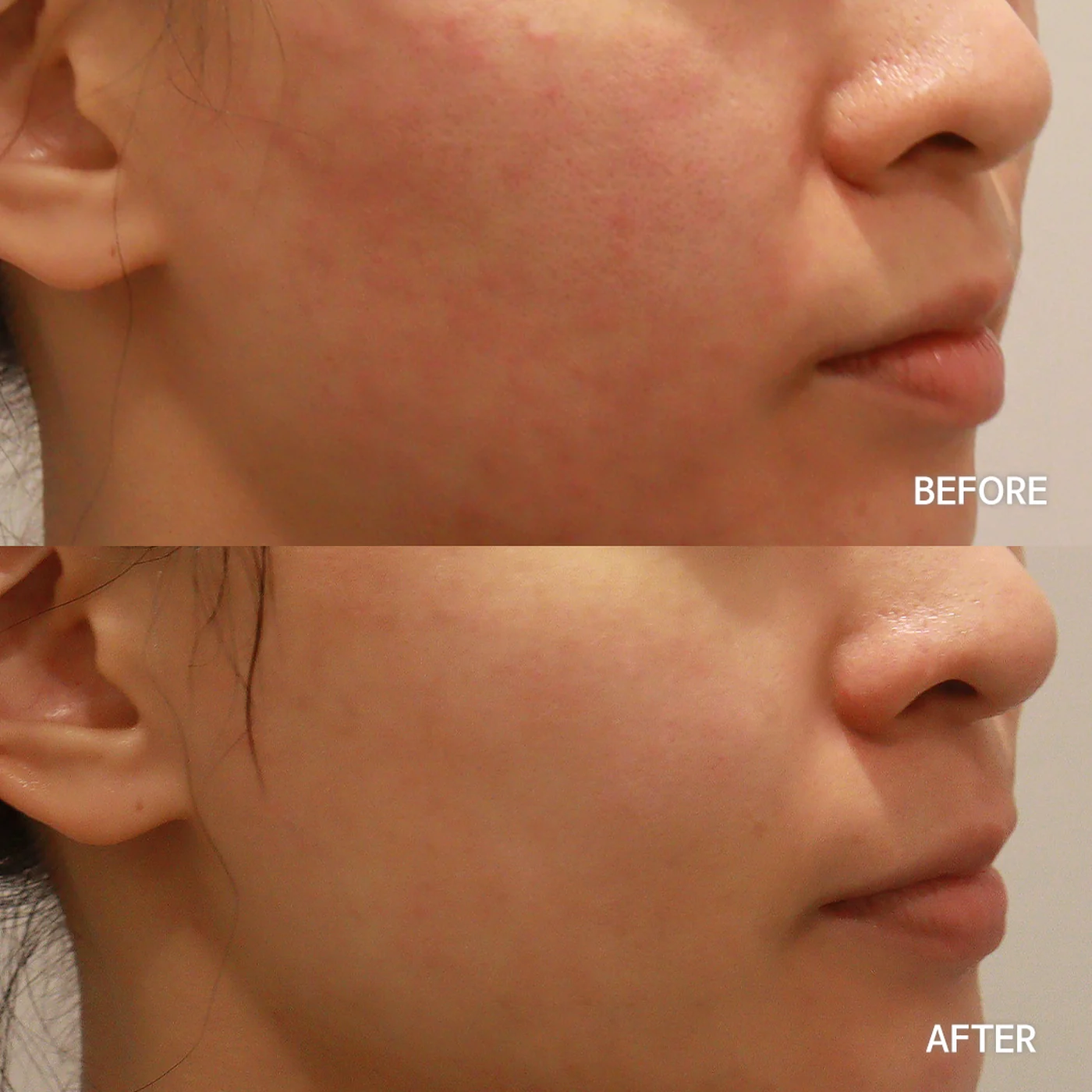 Rejuran skin booster before and after — same patient, calmer, smoother skin texture, Dear Clinic case