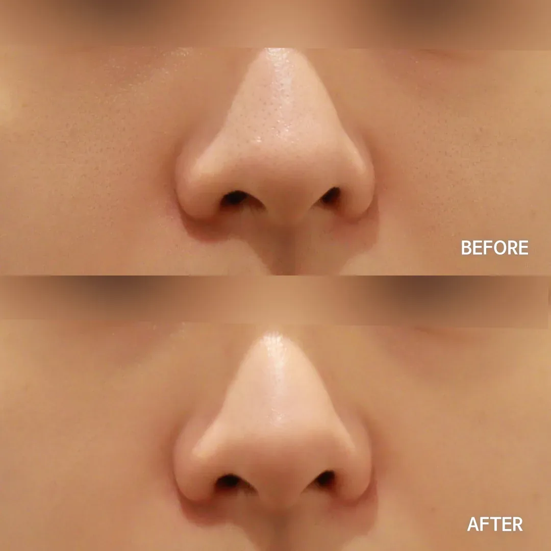 Rejuran before and after — more even, revitalised skin texture, Dear Clinic case