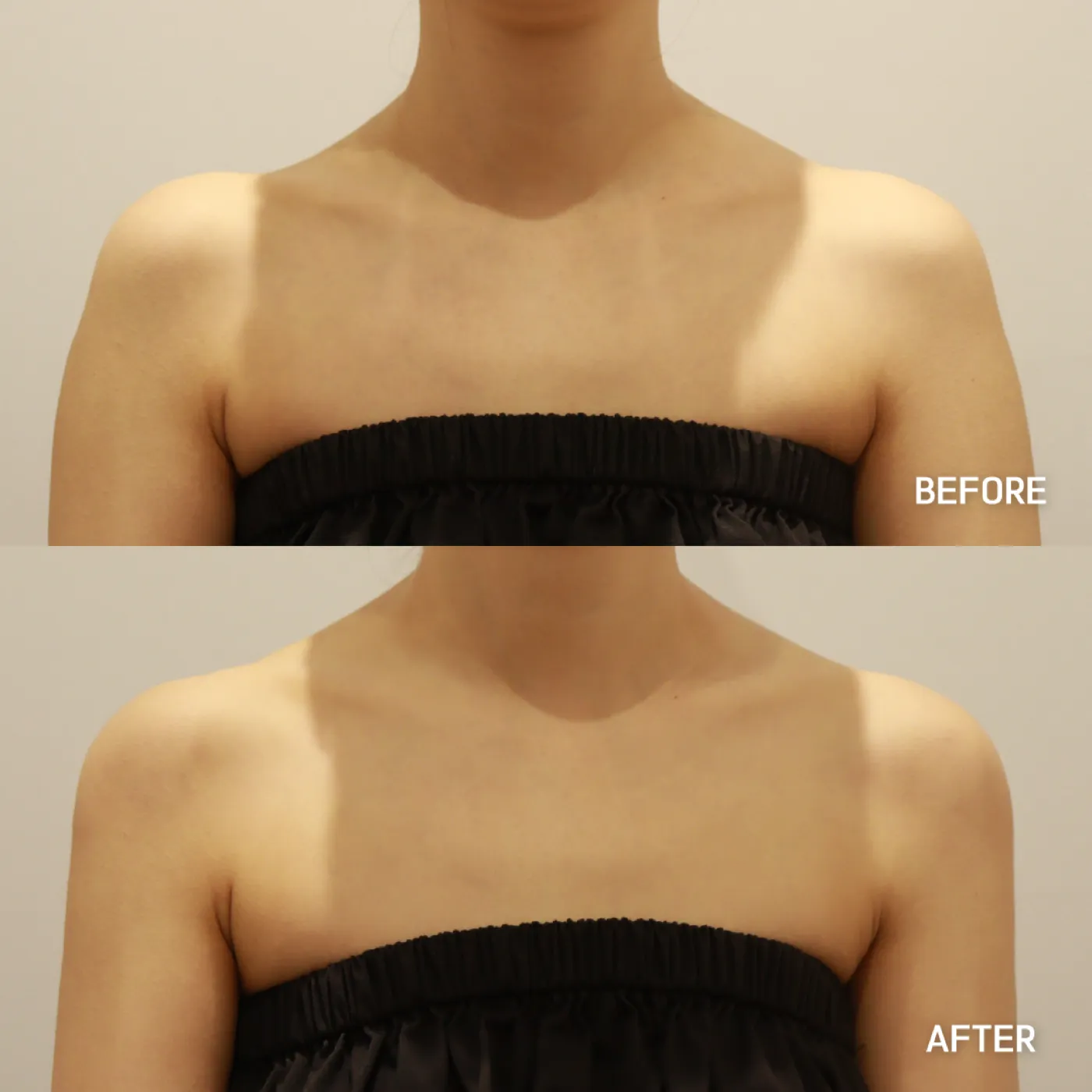 Shoulder filler before and after — Dear Clinic case