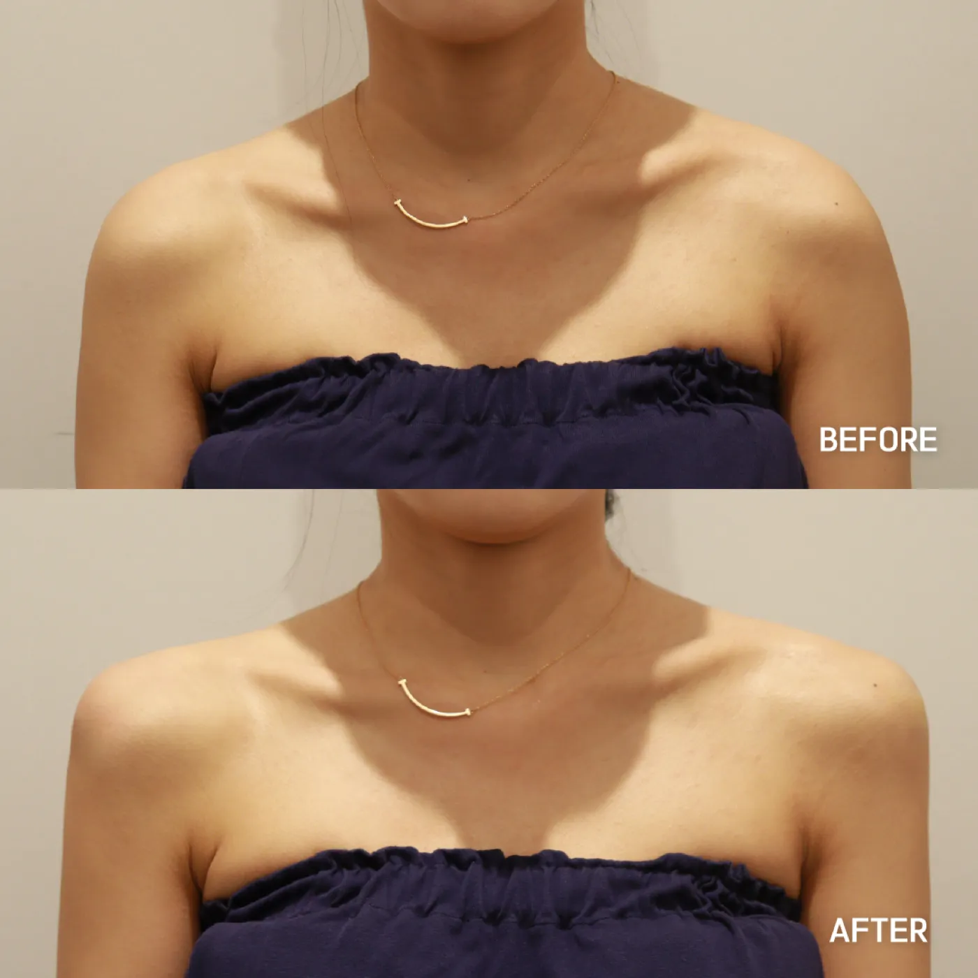 Shoulder line filler before and after — Dear Clinic