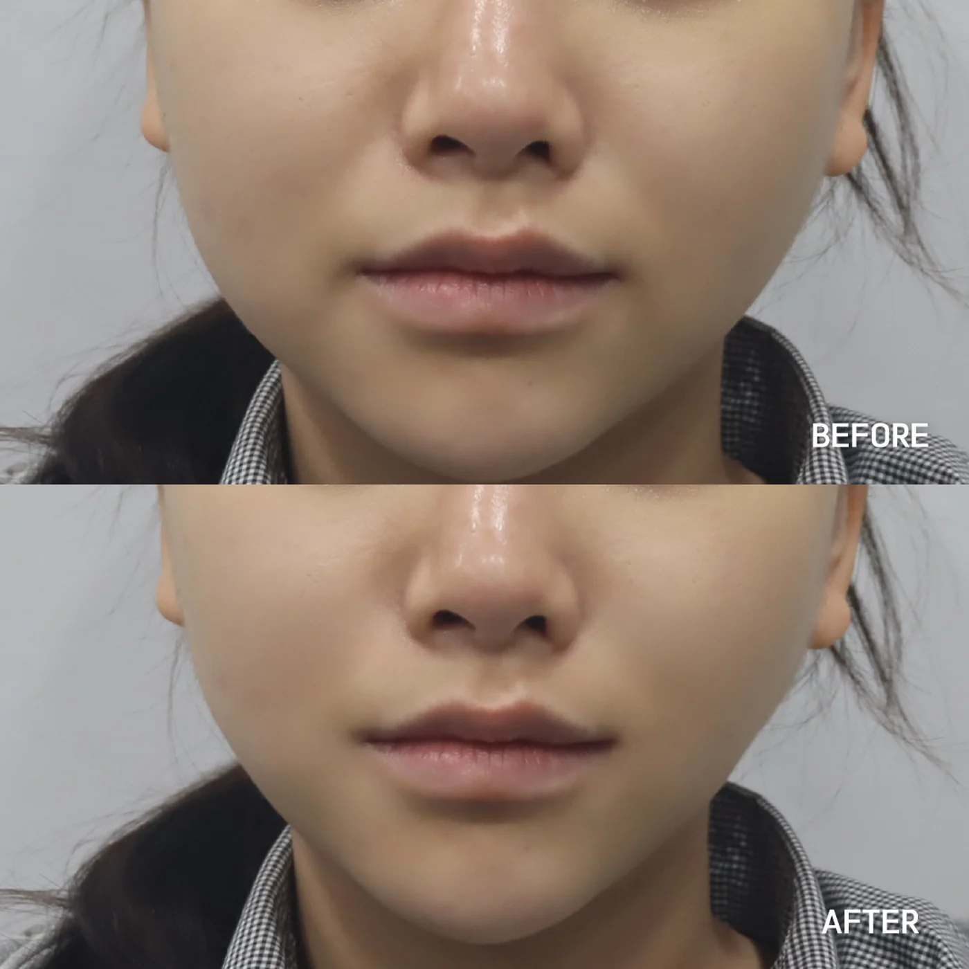 Shurink Universe HIFU lifting before and after — same patient, firmer lower-face contour, Dear Clinic case