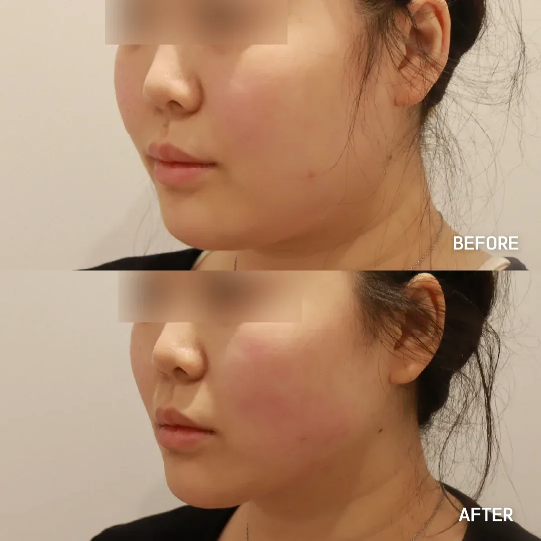 Shurink Universe HIFU lifting before and after — same patient, tighter jawline, Dear Clinic case