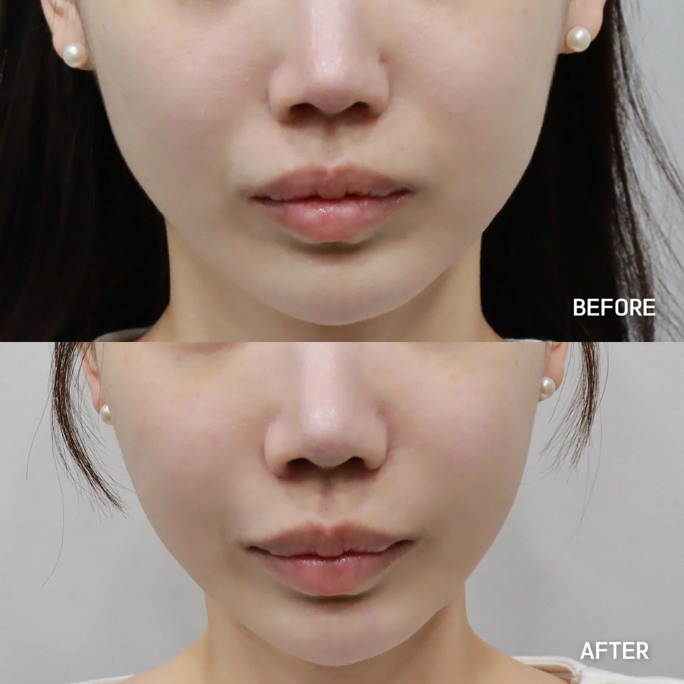 Thread lift before and after — same patient, lifted jawline and softened contour, Dear Clinic case