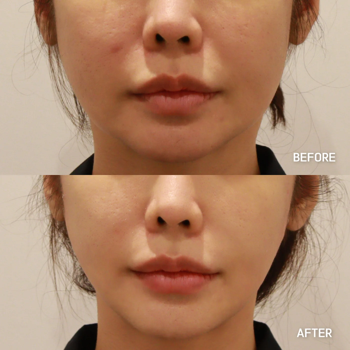 Thread lift before and after — same patient, tighter lower-face line, Dear Clinic case