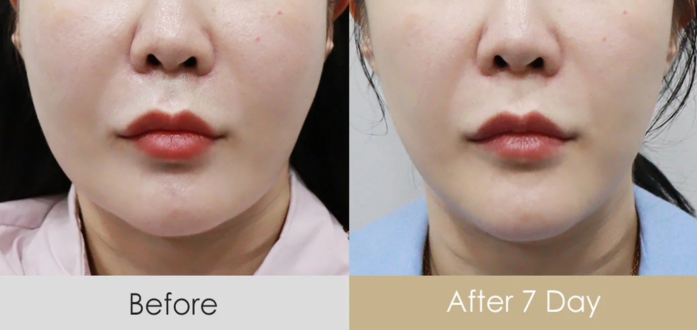 Thread lift before and after — same patient, redrawn jawline one week after treatment, Dear Clinic case