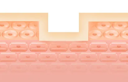 Boxcar acne scar cross-section illustration