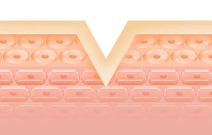 Ice-pick acne scar cross-section illustration