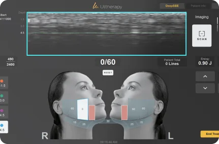 Ultherapy Prime DeepSEE real-time skin layer imaging interface